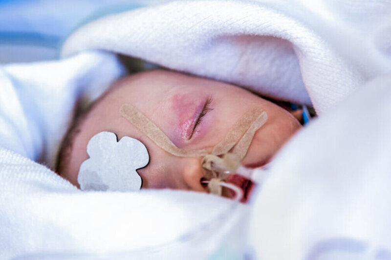 Auf dem Bild ist ein Säugling mit einem Beatmungsgerät zu sehen.
