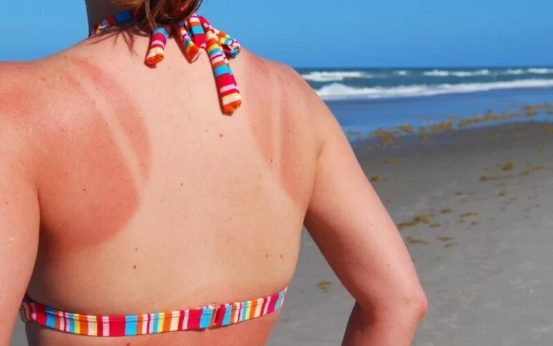 Eine Frau am Strand im Bikini hat von der Sonne verbrannte Schultern.