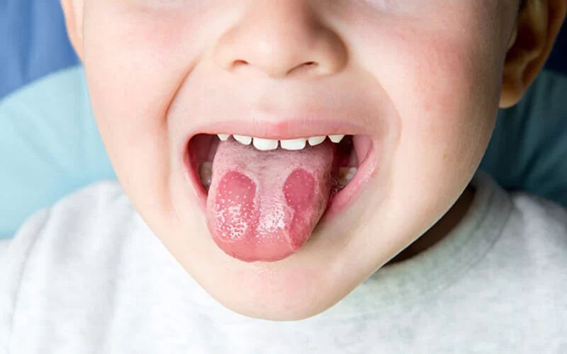 Kind streckt erkrankte Zunge heraus.