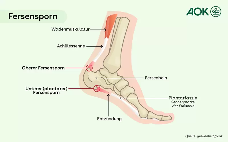 Anatomische Abbildung eines Fußes mit Schwerpunkt Fersensporn.