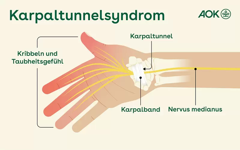 Illustration einer Handfläche mit Lage von Karpaltunnel, Karpalband und Nervus medianus.