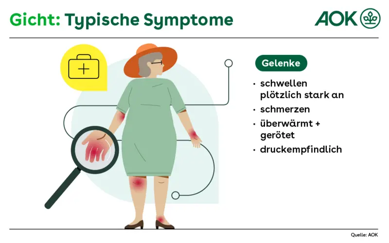 Typische Symptome von Gicht: Die Gelenke schwellen plötzlich stark an, schmerzen, sind überwärmt, gerötet und druckempfindlich