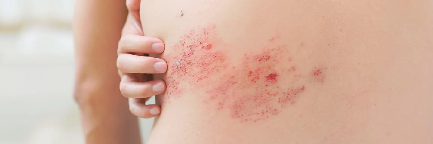 Der unbekleidete Rücken einer nicht erkennbaren Person in Nahaufnahme mit einem Gürtelrose-Ausschlag auf der linken Seite.