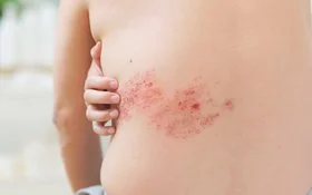 Der unbekleidete Rücken einer nicht erkennbaren Person in Nahaufnahme mit einem Gürtelrose-Ausschlag auf der linken Seite.