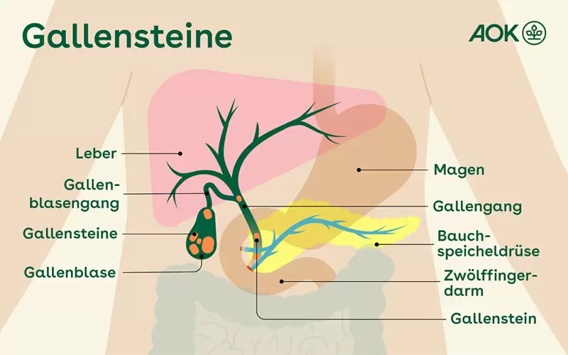 Übersichtsgrafik über die Lage von Gallensteinen.