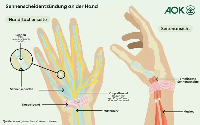 Grafik zum Verlauf der Sehnen in der Hand.