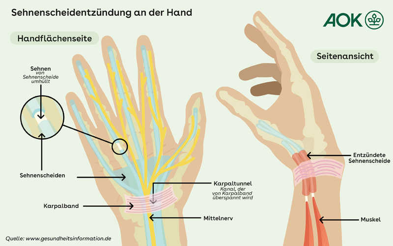 Wie Lange Fällt Man Bei Einer Sehnenscheidenentzündung Aus