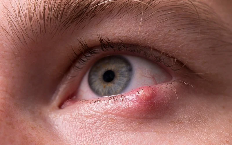 Nahaufnahme des Auges eines Mannes mit einer bakteriellen Infektion einer Öldrüse im unteren Augenlid (Blepharitis).