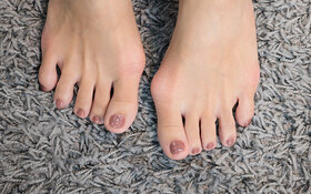 Fuße mit Hallux valgus