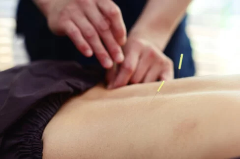 Ein Therapeut setzt Nadeln am Rücken eines Patienten.