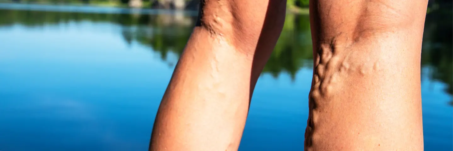 Beine mit Krampfadern, im Hintergrund sieht man einen See mit Bäumen am Ufer.
