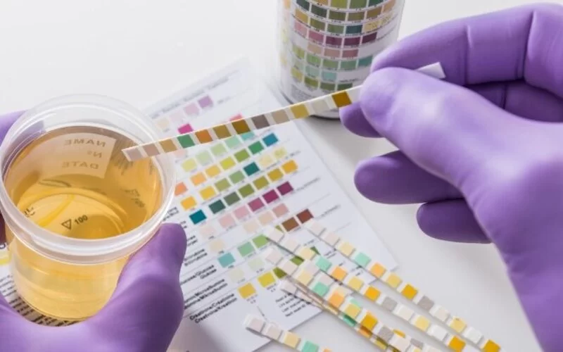 Jemand, der lilafarbene Gummihandschuhe trägt, hält einen Urinteststreifen in einen Becher mit Urin, diverse Teststreifen liegen verteilt auf dem Tisch.