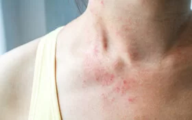Eine Frau hat einen Hautausschlag am Hals.