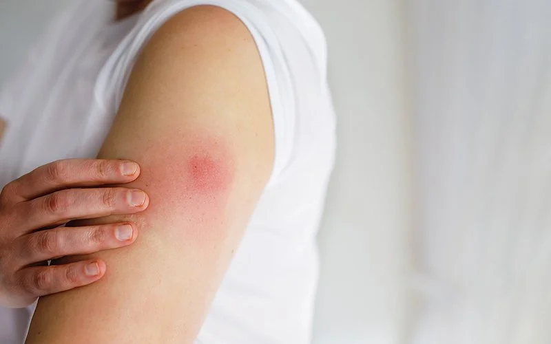 Zu sehen ist der linke Oberarm einer Frau. Nach der Impfung ist die Einstichstelle gerötet und leicht geschwollen.