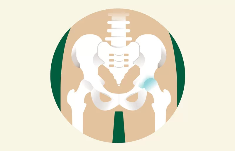 Eine Illustration eines Hüftbeckens, bei dem ein Hüftgelenk Arthrose aufweist.