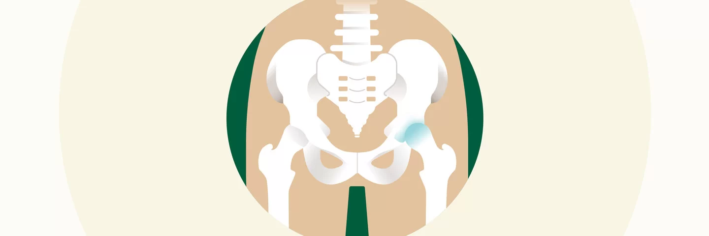 Eine Illustration eines Hüftbeckens, bei dem ein Hüftgelenk Arthrose aufweist.