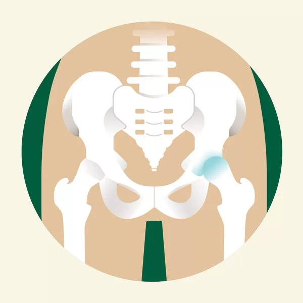 Eine Illustration eines Hüftbeckens, bei dem ein Hüftgelenk Arthrose aufweist.