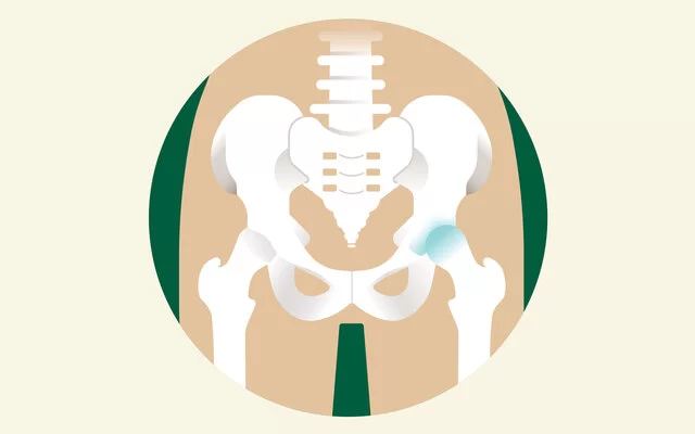Eine Illustration eines Hüftbeckens, bei dem ein Hüftgelenk Arthrose aufweist.