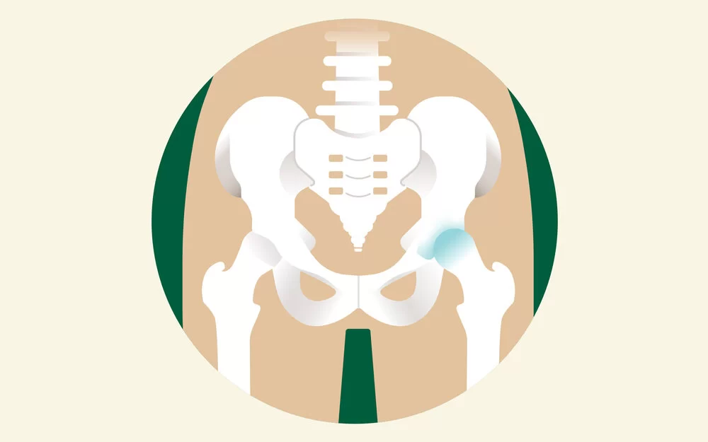 Eine Illustration eines Hüftbeckens, bei dem ein Hüftgelenk Arthrose aufweist.