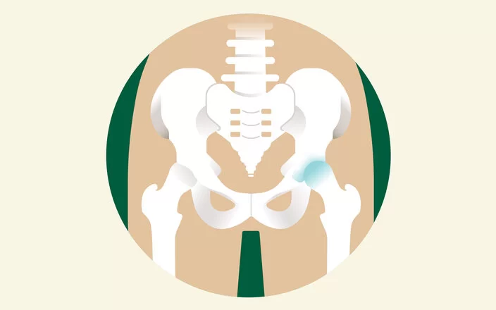 Eine Illustration eines Hüftbeckens, bei dem ein Hüftgelenk Arthrose aufweist.