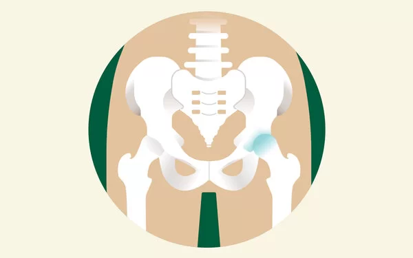 Eine Illustration eines Hüftbeckens, bei dem ein Hüftgelenk Arthrose aufweist.