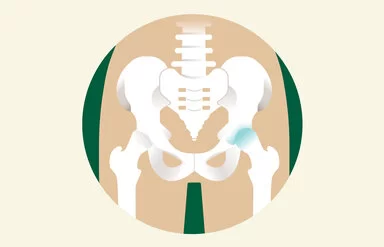 Eine Illustration eines Hüftbeckens, bei dem ein Hüftgelenk Arthrose aufweist.