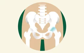 Eine Illustration eines Hüftbeckens, bei dem ein Hüftgelenk Arthrose aufweist.