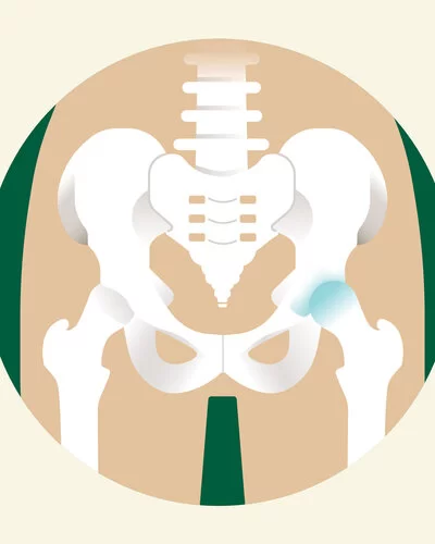 Eine Illustration eines Hüftbeckens, bei dem ein Hüftgelenk Arthrose aufweist.