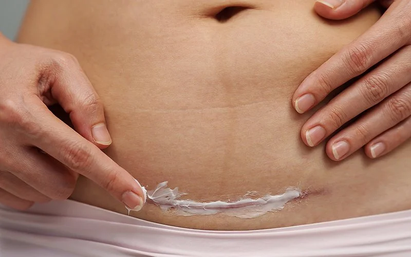 Eine Frau trägt Creme auf eine Narbe an ihrem Bauch auf.