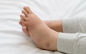 Geschwollene Füße einer Frau, die auf einem Bett liegen.