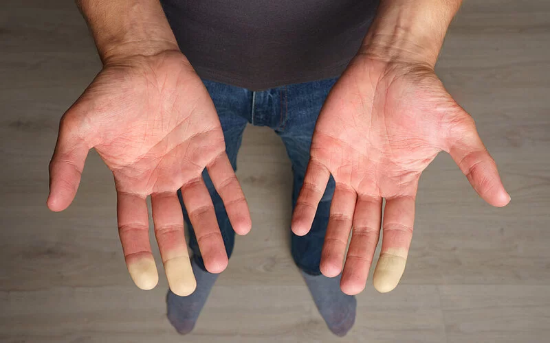Mann mit Lupus Erythematodes zeigt Hände mit gefärbten Fingerkuppen.