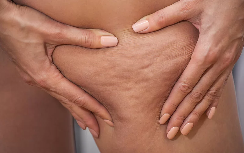 Eine Frau überprüft mit den Fingern den Grad ihrer Cellulite.