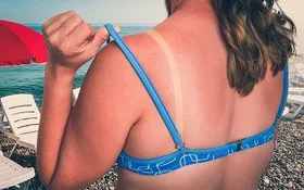 Eine Frau im blauen Bikini hat einen Sonnenbrand auf dem gesamten Rücken.