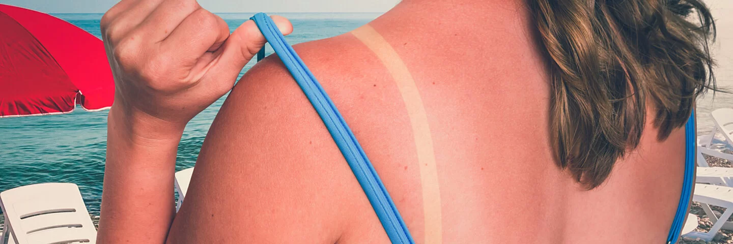 Eine Frau im blauen Bikini hat einen Sonnenbrand auf dem gesamten Rücken.