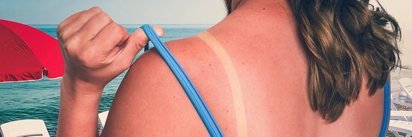 Eine Frau im blauen Bikini hat einen Sonnenbrand auf dem gesamten Rücken.
