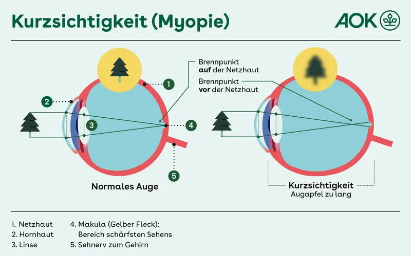 Eine grafische Darstellung zeigt ein normales Auge im Vergleich zu einem kurzsichtigen Auge. Beim normalen Auge werden die Bestandteile gezeigt: Netzhaut, Hornhaut, Linse, Makula und Sehnerv sowie die Lichtbrechung in der Hornhaut und der Linse. Beim kurzsichtigen Auge ist der Augapfel länger. Die Lichtbrechung ist daher verschoben, was zu unscharfem Sehen führt.
