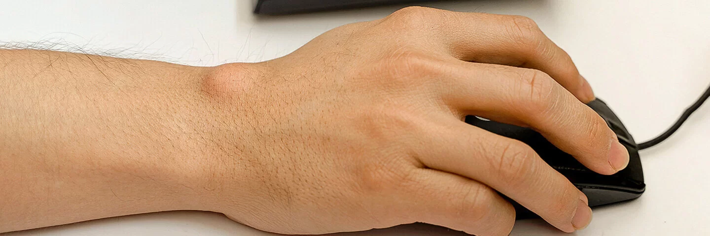 Großaufnahme eines Ganglions an einer rechten Hand, die eine Computermaus bedient.