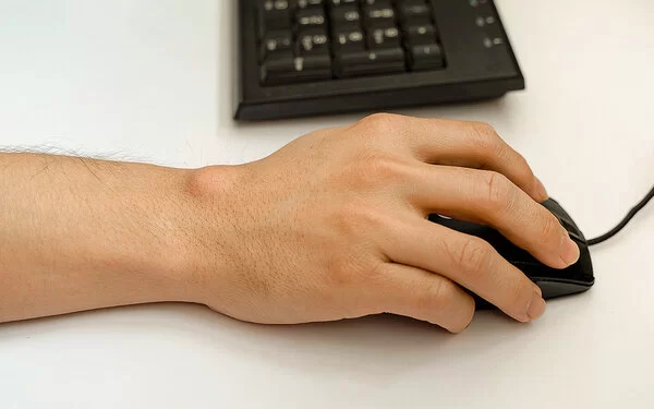 Großaufnahme eines Ganglions an einer rechten Hand, die eine Computermaus bedient.