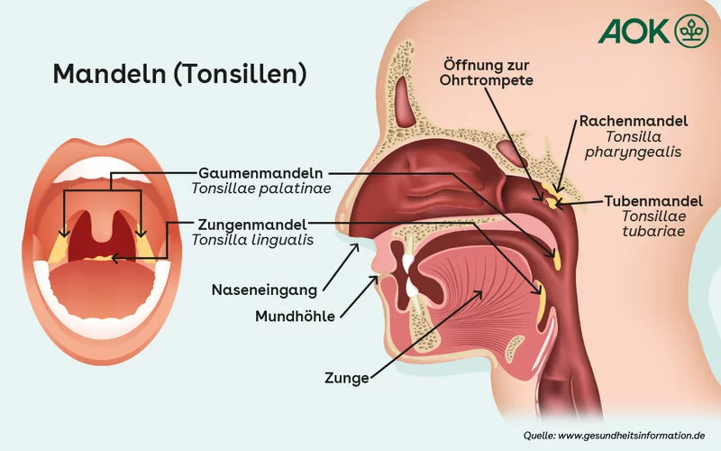 Grafik mit den Tonsillen (Mandeln) im Rachenraum