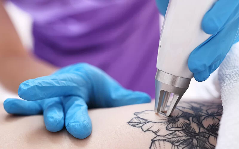 Ein schwarzes Tattoo wird mit einem Lasergerät entfernt.