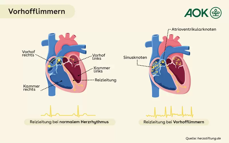 Zu sehen sind zwei Herzen, eines davon leidet unter Vorhofflimmern.
