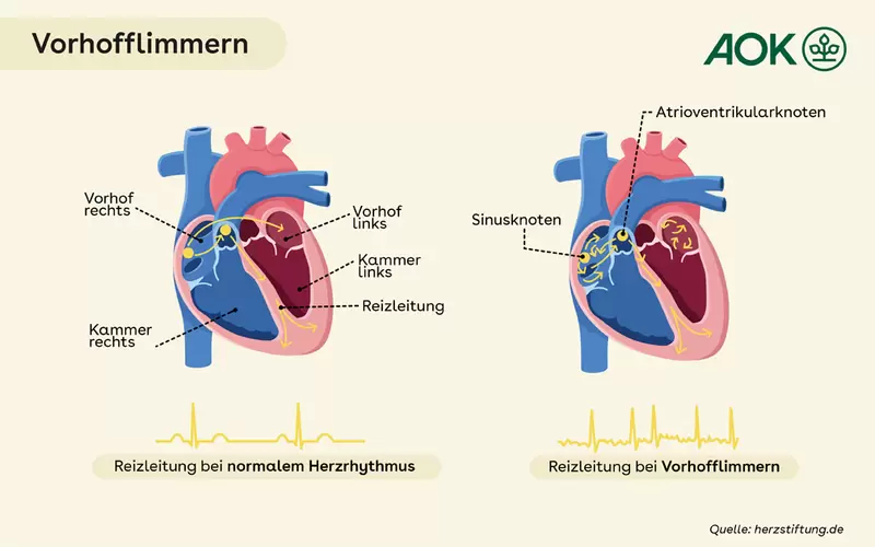 Alternative Zur Blutverdünnung Bei Vorhofflimmern www.aok.de
