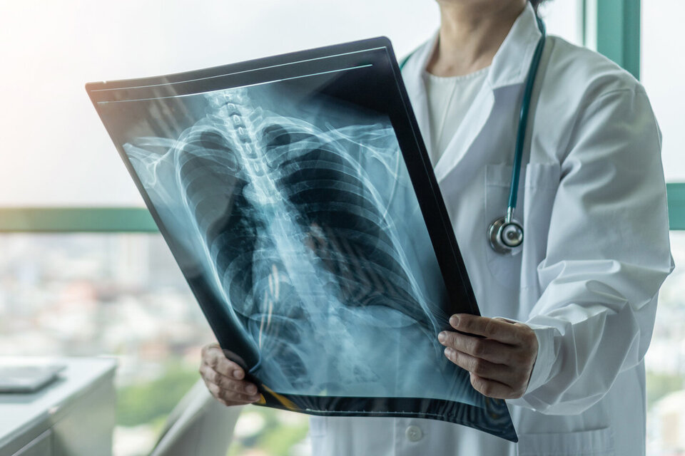 Eine Ärztin betrachtet das Röntgenbild eines Brustkorbs. Diese Untersuchung liefert erste Hinweise auf Lungenkrebs.