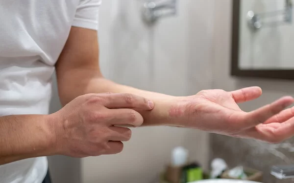 Großaufnahme von beiden Unterarmen einer jungen Person, die Neurodermitis hat und sich kratzt.