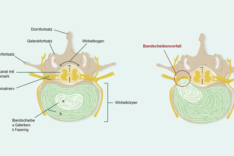 	 Ein grafischer Querschnitt der Bandscheibe zeigt den Aufbau der Bandscheibe und ihrer Umgebung. Bei einem Bandscheibenvorfall wölbt sich die Banscheibe buchstäblich vor.