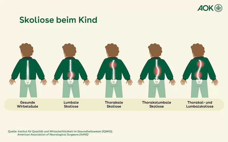 Schaubild verschiedener Arten der Skoliose beim Kind.