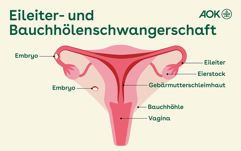 Eileiterschwangerschaft: Welche Symptome gibt es?