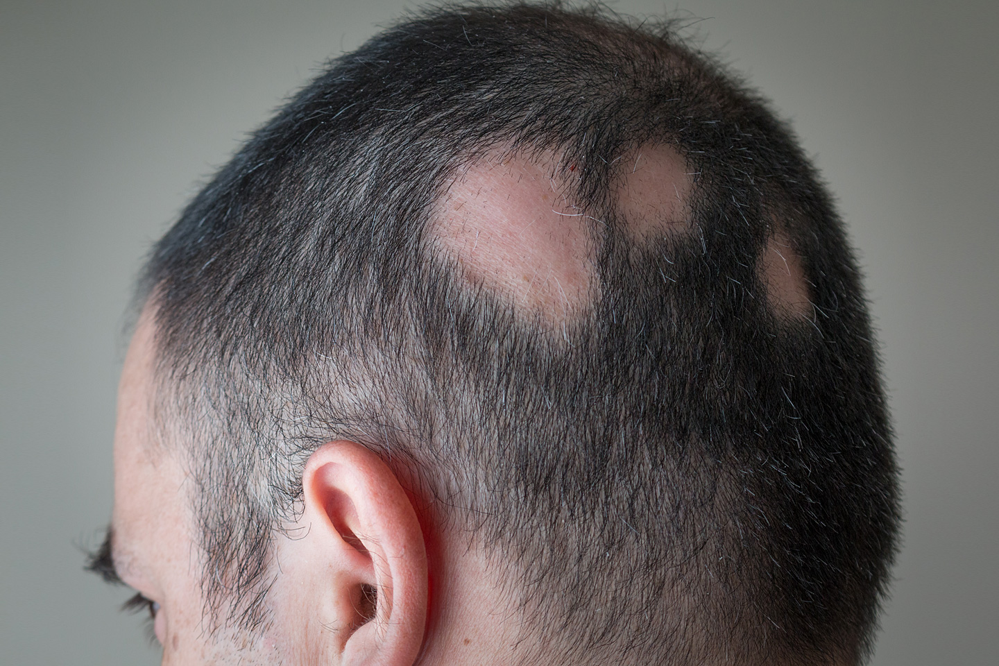 Ansicht des Hinterkopfs eines Mannes mit kahlen Stellen. Der Mann leidet unter kreisrundem Haarausfall.