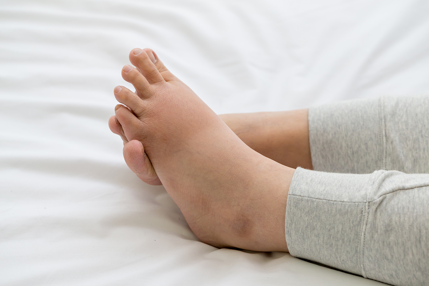 Geschwollene Füße einer Frau, die auf einem Bett liegen.