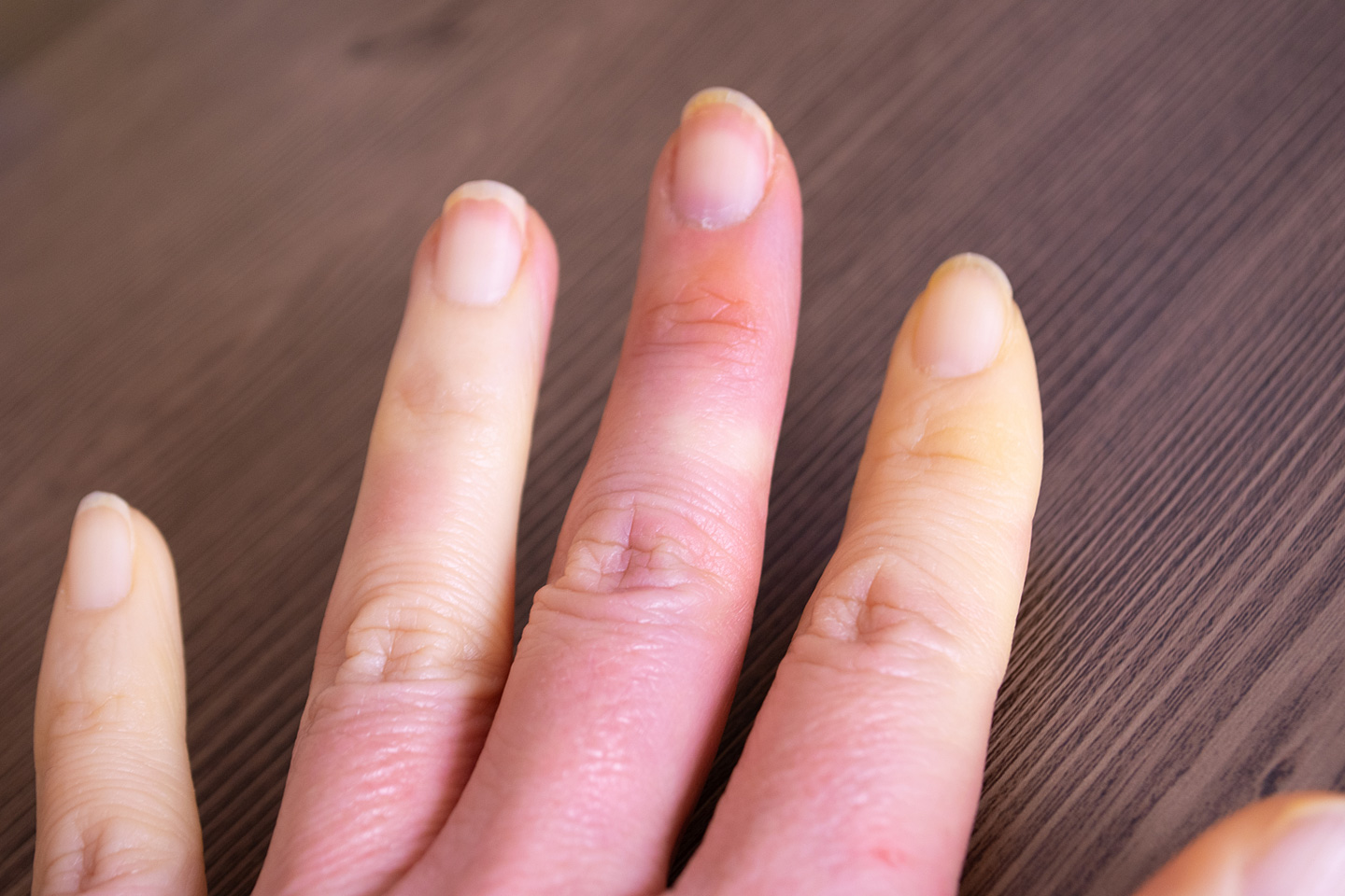 Was verbirgt sich hinter dem Raynaud-Syndrom?